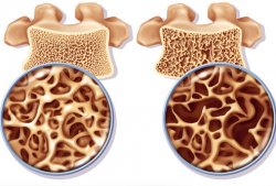 Alimente care ajută la fixarea calciului în oase și previn osteoporoza Alimente care ajută la fixarea calciului în oase și previn osteoporoza