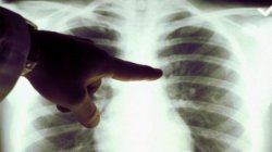 Rata îmbolnăvirilor de tuberculoză s-a diminuat Rata îmbolnăvirilor de tuberculoză s-a diminuat