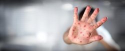 OMS avertizează că rujeola omoară în continuare oameni OMS avertizează că rujeola omoară în continuare oameni