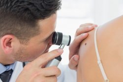 Cum îţi dai seama dacă aluniţele tale sunt cancerigene Cum îţi dai seama dacă aluniţele tale sunt cancerigene